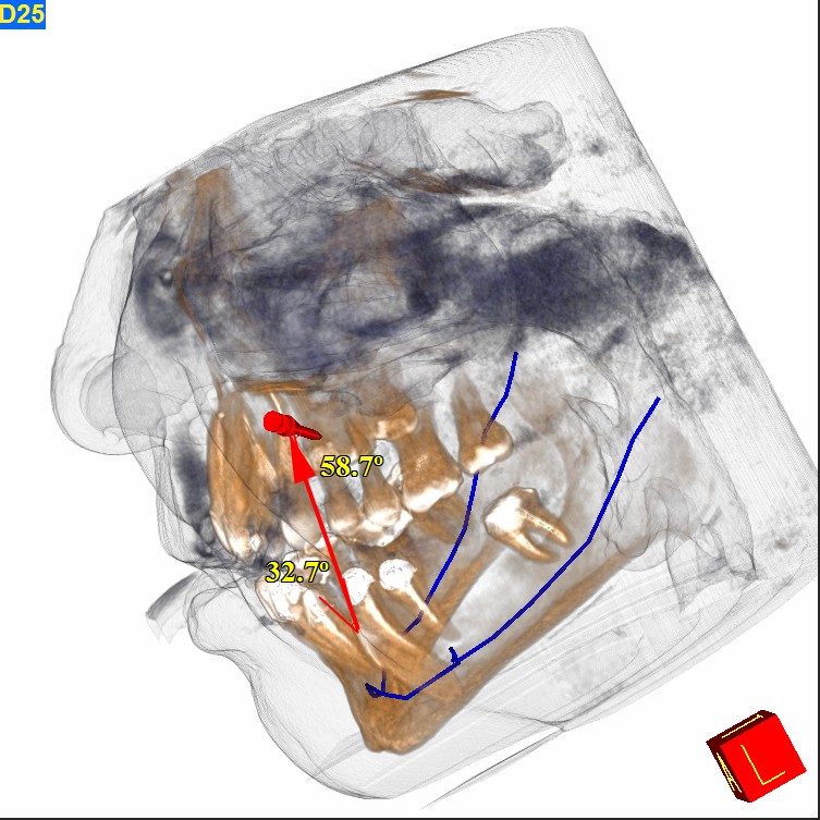 Ortodontie 3D angulat