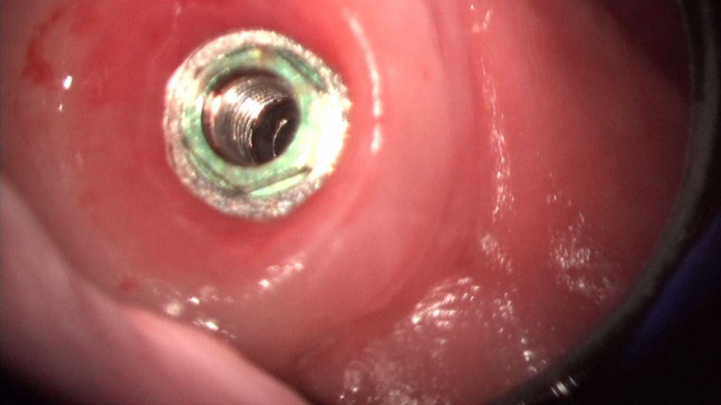 implante imputite datorita instabilitatii bontului (efectul de pompa microbiana) (17) (FILEminimizer)