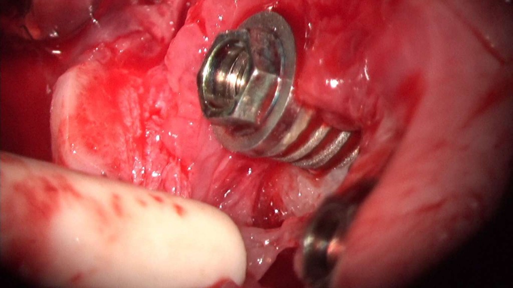 implante imputite datorita instabilitatii bontului (efectul de pompa microbiana) (24) (FILEminimizer)