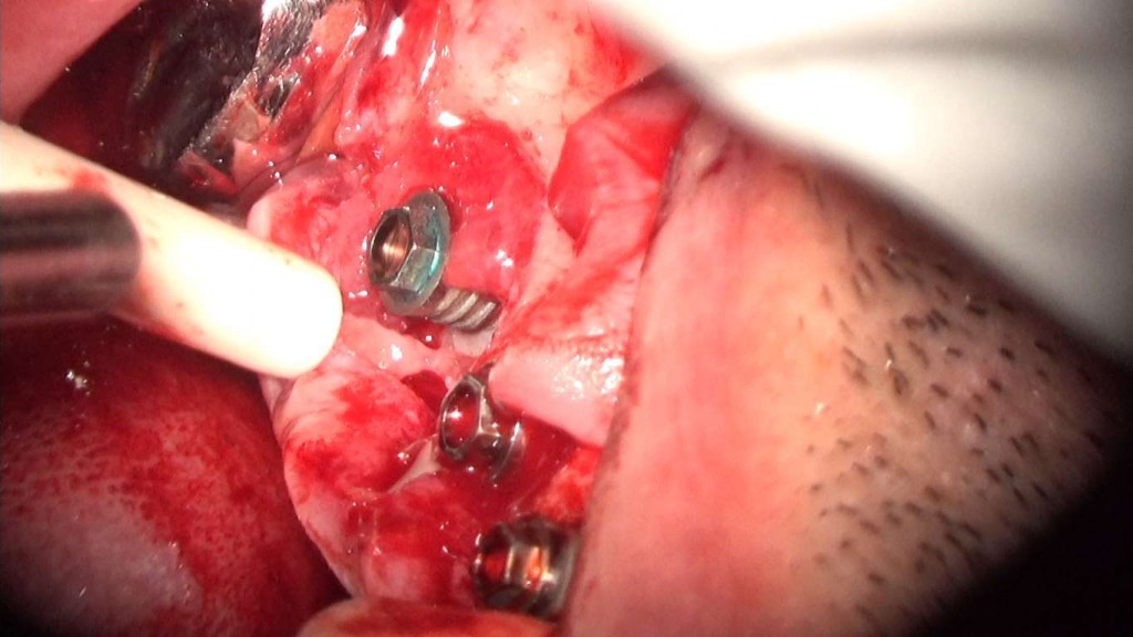 implante imputite datorita instabilitatii bontului (efectul de pompa microbiana) (26) (FILEminimizer)