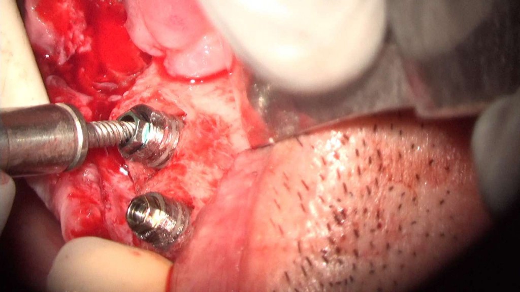 implante imputite datorita instabilitatii bontului (efectul de pompa microbiana) (30) (FILEminimizer)