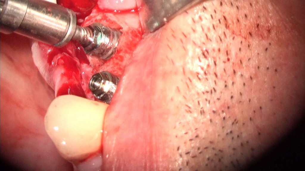 implante imputite datorita instabilitatii bontului (efectul de pompa microbiana) (31) (FILEminimizer)