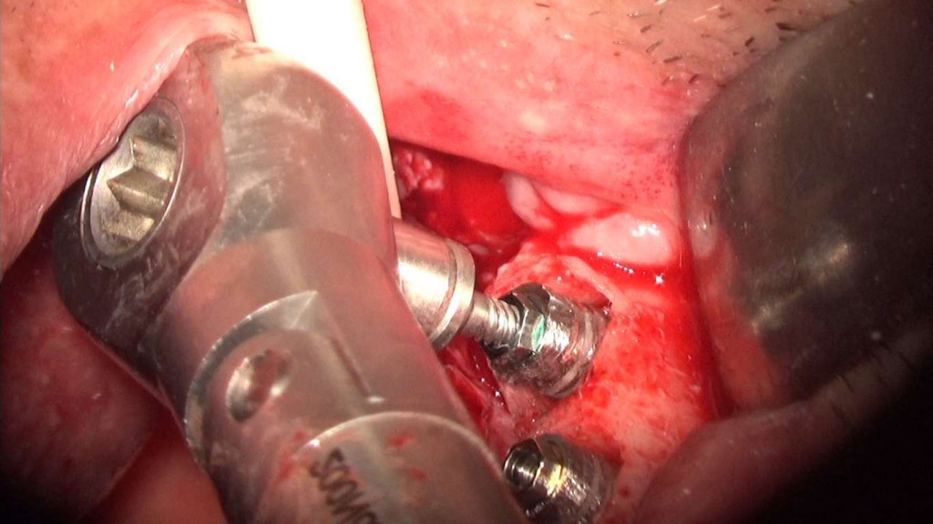 implante imputite datorita instabilitatii bontului (efectul de pompa microbiana) (33) (FILEminimizer)