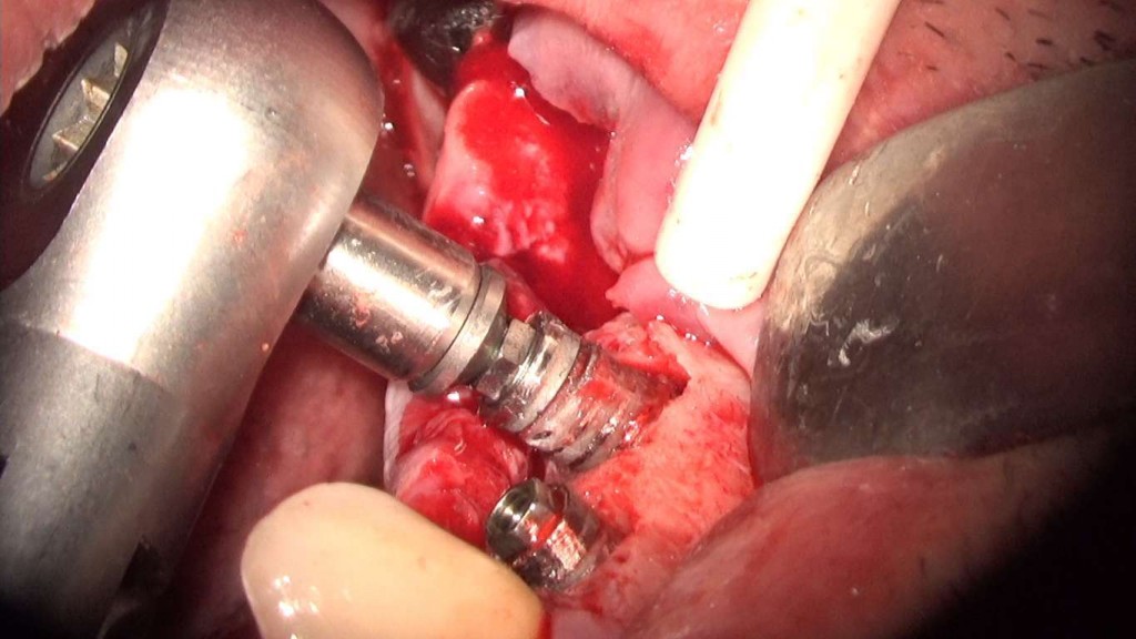 implante imputite datorita instabilitatii bontului (efectul de pompa microbiana) (34) (FILEminimizer)