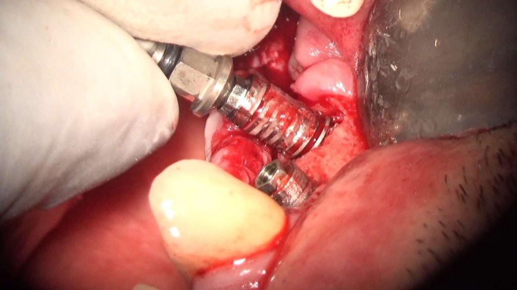 implante imputite datorita instabilitatii bontului (efectul de pompa microbiana) (35) (FILEminimizer)