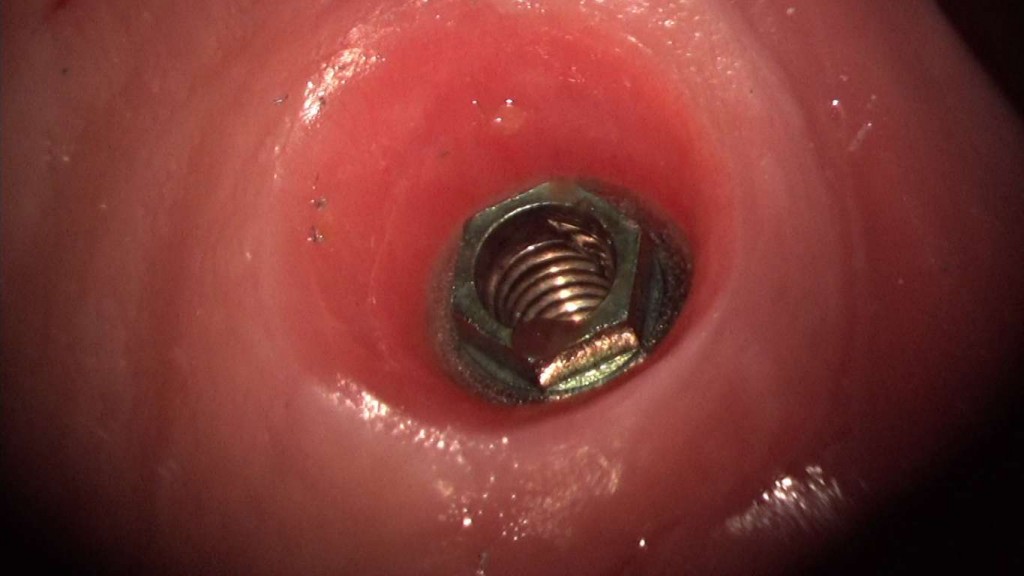 implante imputite datorita instabilitatii bontului (efectul de pompa microbiana) (5) (FILEminimizer)