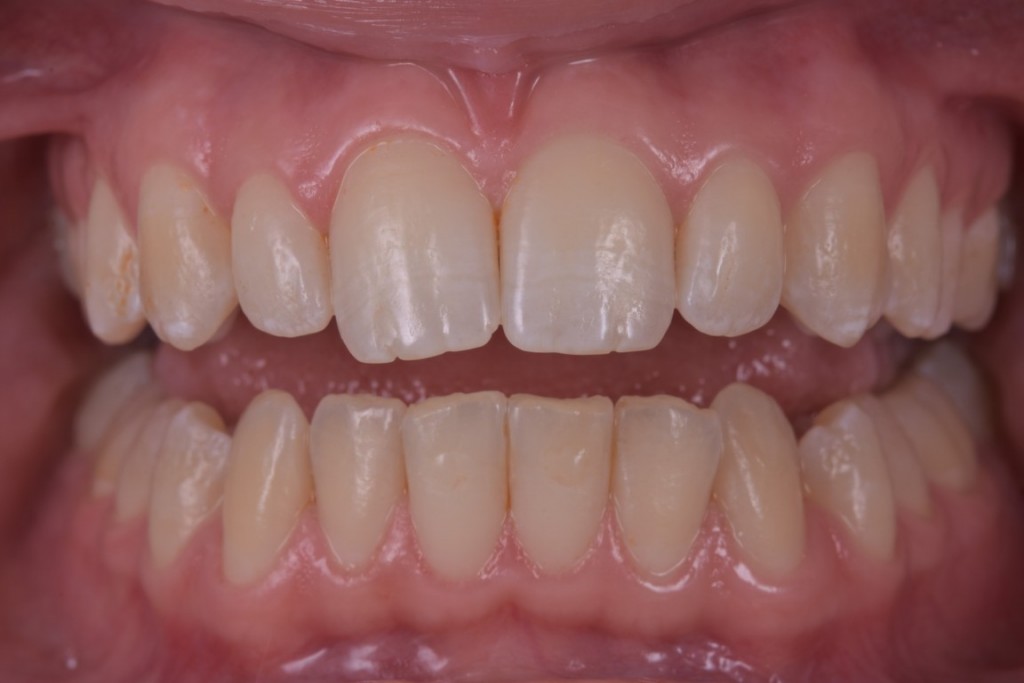 Fluoroza dentara (1) (FILEminimizer)