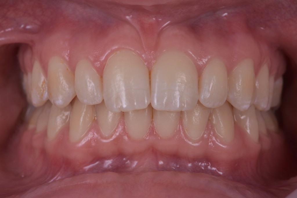 Fluoroza dentara (2) (FILEminimizer)