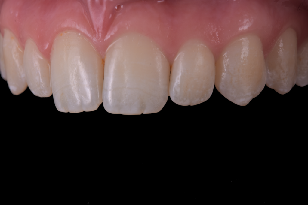 Fluoroza dentara intraoral (2)