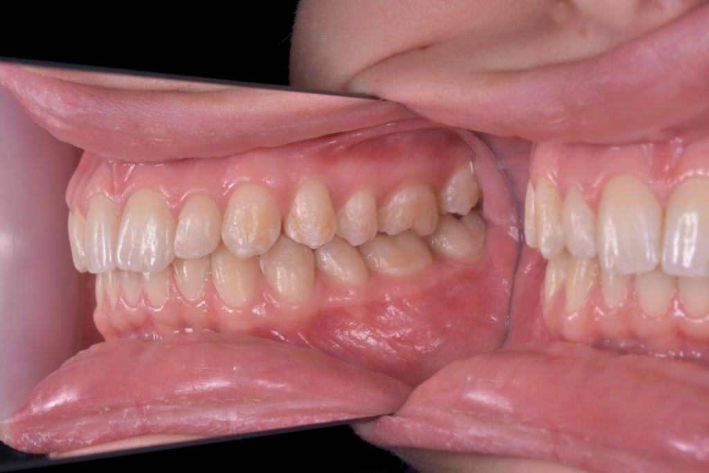 Fluoroza dentara intraoral (5)