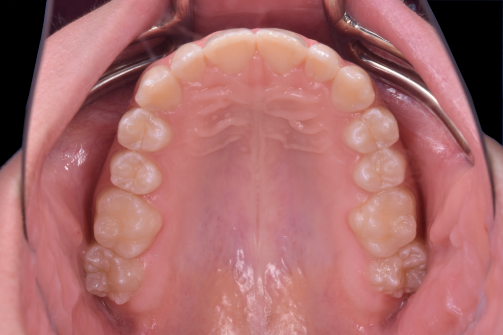 Fluoroza dentara intraoral (7)